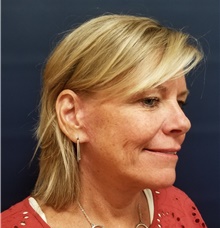 Facelift After Photo by Noel Natoli, MD, FACS; East Hills, NY - Case 41899