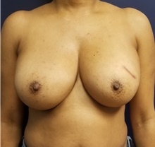 Breast Reconstruction Before Photo by Noel Natoli, MD, FACS; East Hills, NY - Case 41900
