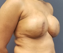 Breast Reconstruction After Photo by Noel Natoli, MD, FACS; East Hills, NY - Case 41900