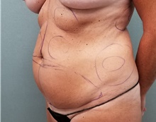 Tummy Tuck Before Photo by Noel Natoli, MD, FACS; East Hills, NY - Case 41901