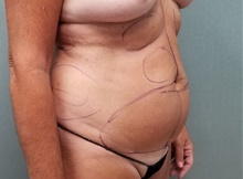 Tummy Tuck Before Photo by Noel Natoli, MD, FACS; East Hills, NY - Case 41901