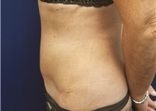 Tummy Tuck After Photo by Noel Natoli, MD, FACS; East Hills, NY - Case 41901