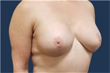 Breast Reconstruction After Photo by Noel Natoli, MD, FACS; East Hills, NY - Case 41902