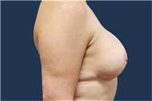 Breast Reconstruction After Photo by Noel Natoli, MD, FACS; East Hills, NY - Case 41902