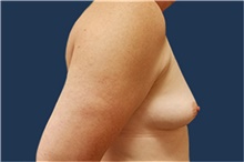 Breast Reconstruction Before Photo by Noel Natoli, MD, FACS; East Hills, NY - Case 41902