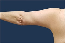 Arm Lift After Photo by Noel Natoli, MD, FACS; East Hills, NY - Case 41903