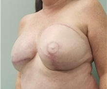 Breast Reconstruction After Photo by Noel Natoli, MD, FACS; East Hills, NY - Case 41905