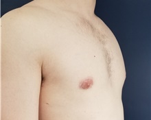 Male Breast Reduction After Photo by Noel Natoli, MD, FACS; East Hills, NY - Case 41908