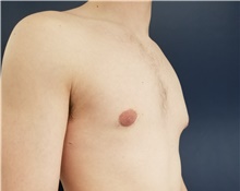 Male Breast Reduction Before Photo by Noel Natoli, MD, FACS; East Hills, NY - Case 41908