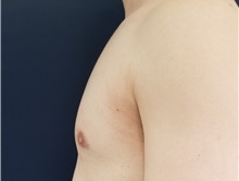Male Breast Reduction After Photo by Noel Natoli, MD, FACS; East Hills, NY - Case 41908
