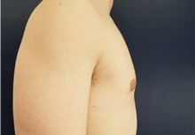 Male Breast Reduction Before Photo by Noel Natoli, MD, FACS; East Hills, NY - Case 41908