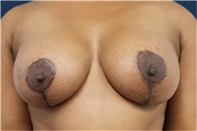 Breast Lift After Photo by Noel Natoli, MD, FACS; East Hills, NY - Case 41914