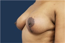 Breast Lift After Photo by Noel Natoli, MD, FACS; East Hills, NY - Case 41914