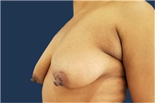Breast Lift Before Photo by Noel Natoli, MD, FACS; East Hills, NY - Case 41914