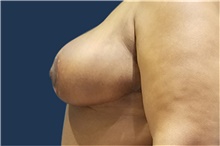 Breast Reduction After Photo by Noel Natoli, MD, FACS; East Hills, NY - Case 41915