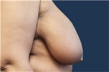 Breast Reduction Before Photo by Noel Natoli, MD, FACS; East Hills, NY - Case 41915