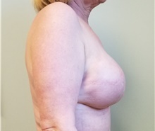 Breast Reconstruction After Photo by Noel Natoli, MD, FACS; East Hills, NY - Case 41916