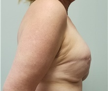 Breast Reconstruction Before Photo by Noel Natoli, MD, FACS; East Hills, NY - Case 41916