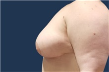 Breast Reduction After Photo by Noel Natoli, MD, FACS; East Hills, NY - Case 41918