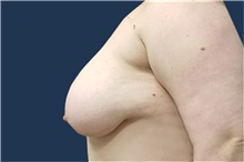 Breast Reduction Before Photo by Noel Natoli, MD, FACS; East Hills, NY - Case 41918
