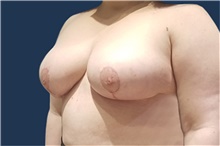 Breast Reduction After Photo by Noel Natoli, MD, FACS; East Hills, NY - Case 41918