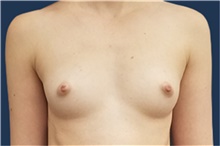 Breast Augmentation Before Photo by Noel Natoli, MD, FACS; East Hills, NY - Case 41919
