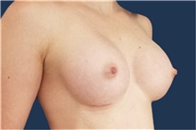 Breast Augmentation After Photo by Noel Natoli, MD, FACS; East Hills, NY - Case 41919
