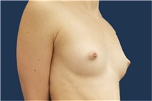 Breast Augmentation Before Photo by Noel Natoli, MD, FACS; East Hills, NY - Case 41919