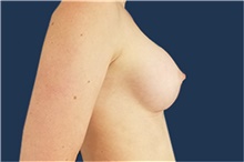 Breast Augmentation After Photo by Noel Natoli, MD, FACS; East Hills, NY - Case 41919