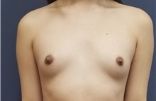 Breast Augmentation Before Photo by Noel Natoli, MD, FACS; East Hills, NY - Case 41922