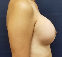 Breast Augmentation After Photo by Noel Natoli, MD, FACS; East Hills, NY - Case 41922