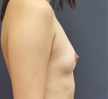 Breast Augmentation Before Photo by Noel Natoli, MD, FACS; East Hills, NY - Case 41922
