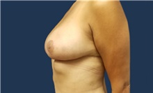Breast Reduction After Photo by Noel Natoli, MD, FACS; East Hills, NY - Case 41928