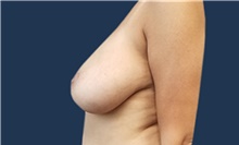 Breast Reduction Before Photo by Noel Natoli, MD, FACS; East Hills, NY - Case 41928