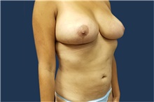 Liposuction After Photo by Noel Natoli, MD, FACS; East Hills, NY - Case 41929
