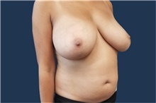 Liposuction Before Photo by Noel Natoli, MD, FACS; East Hills, NY - Case 41929