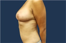 Liposuction After Photo by Noel Natoli, MD, FACS; East Hills, NY - Case 41929