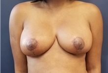 Breast Reduction After Photo by Noel Natoli, MD, FACS; East Hills, NY - Case 41930