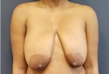 Breast Reduction Before Photo by Noel Natoli, MD, FACS; East Hills, NY - Case 41930