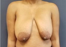 Breast Lift Before Photo by Noel Natoli, MD, FACS; East Hills, NY - Case 41931