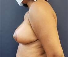 Breast Lift After Photo by Noel Natoli, MD, FACS; East Hills, NY - Case 41931