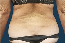 Liposuction After Photo by Noel Natoli, MD, FACS; East Hills, NY - Case 41932