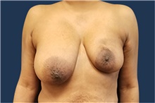 Breast Reconstruction Before Photo by Noel Natoli, MD, FACS; East Hills, NY - Case 41934