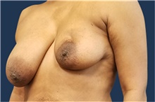 Breast Reconstruction Before Photo by Noel Natoli, MD, FACS; East Hills, NY - Case 41934