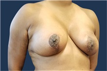 Breast Reconstruction After Photo by Noel Natoli, MD, FACS; East Hills, NY - Case 41934