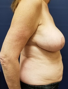 Liposuction After Photo by Noel Natoli, MD, FACS; East Hills, NY - Case 43307