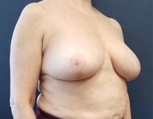 Breast Reduction After Photo by Noel Natoli, MD, FACS; East Hills, NY - Case 43308