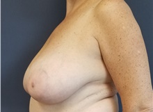 Breast Reduction Before Photo by Noel Natoli, MD, FACS; East Hills, NY - Case 43308