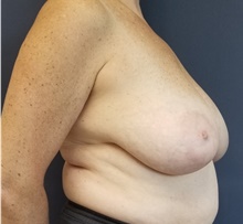 Breast Reduction Before Photo by Noel Natoli, MD, FACS; East Hills, NY - Case 43308