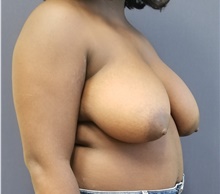 Breast Reduction Before Photo by Noel Natoli, MD, FACS; East Hills, NY - Case 43310